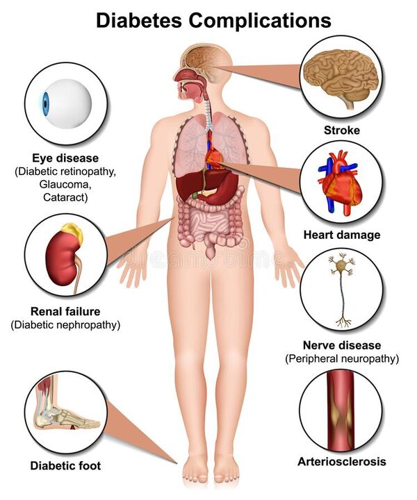 Conseguenze del diabete